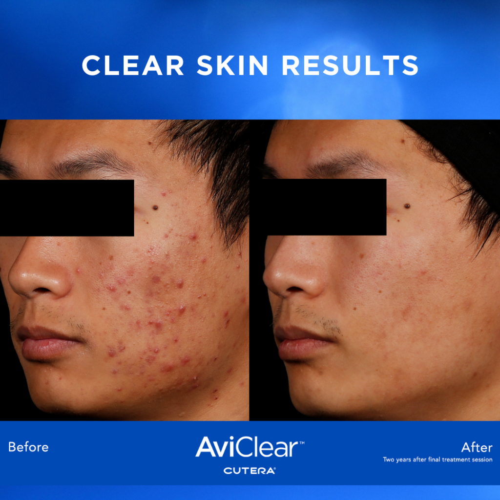 AviClear Laser Acne Treatment in Houston and Greater Houston, TX