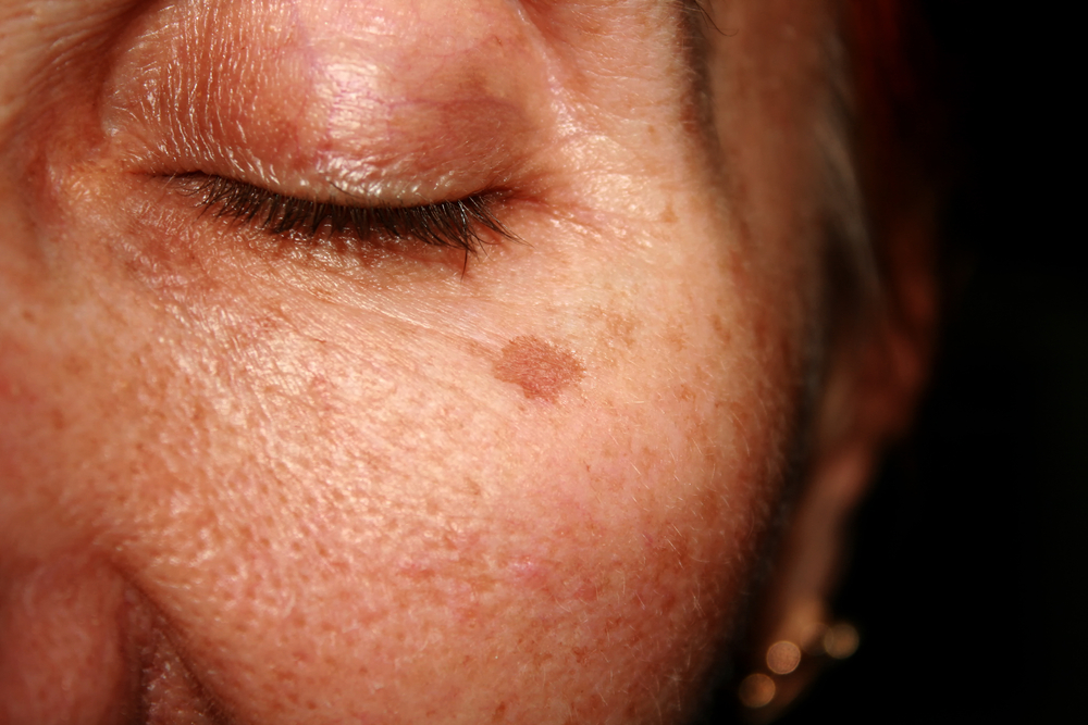 Age Spot Treatment in Houston and Greater Houston, TX
