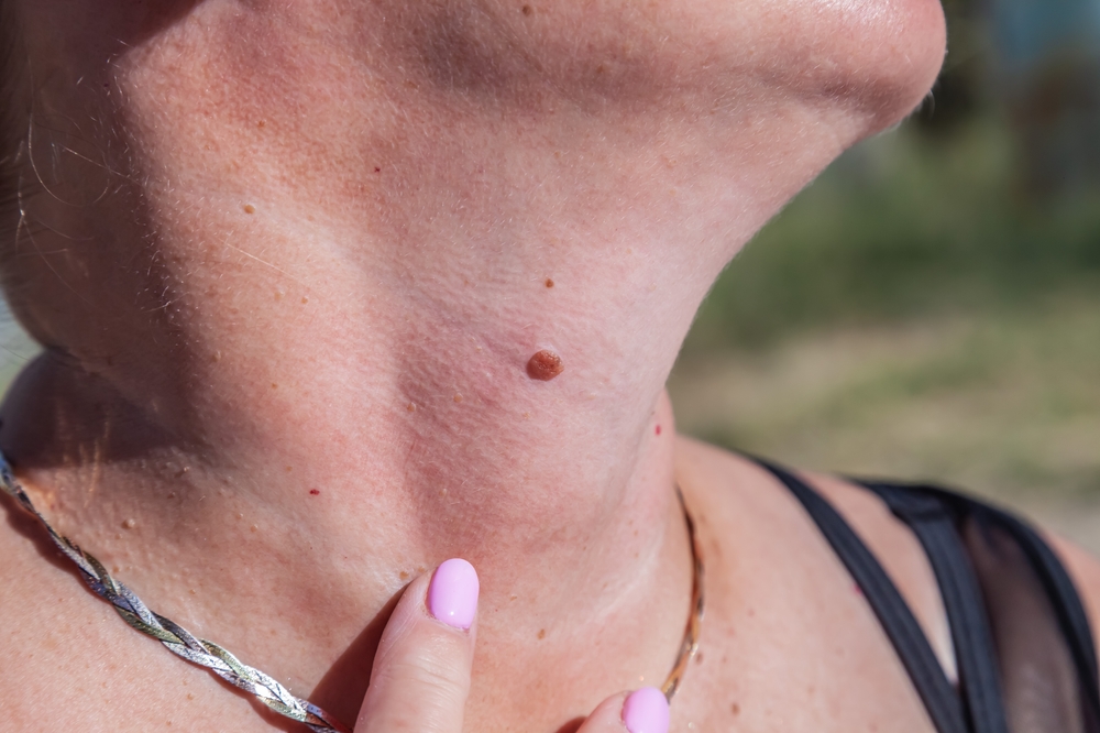Mole Check Image
