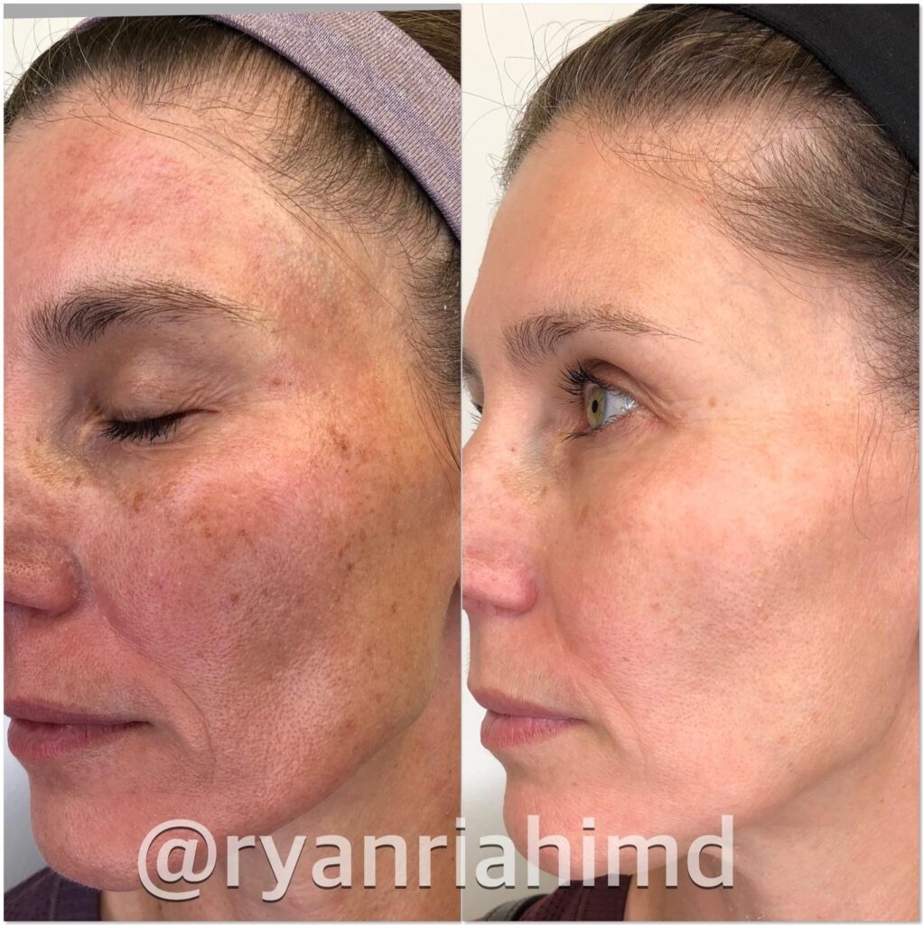 Intense Pulsed Light IPL Treatment in Houston and Greater Houston TX