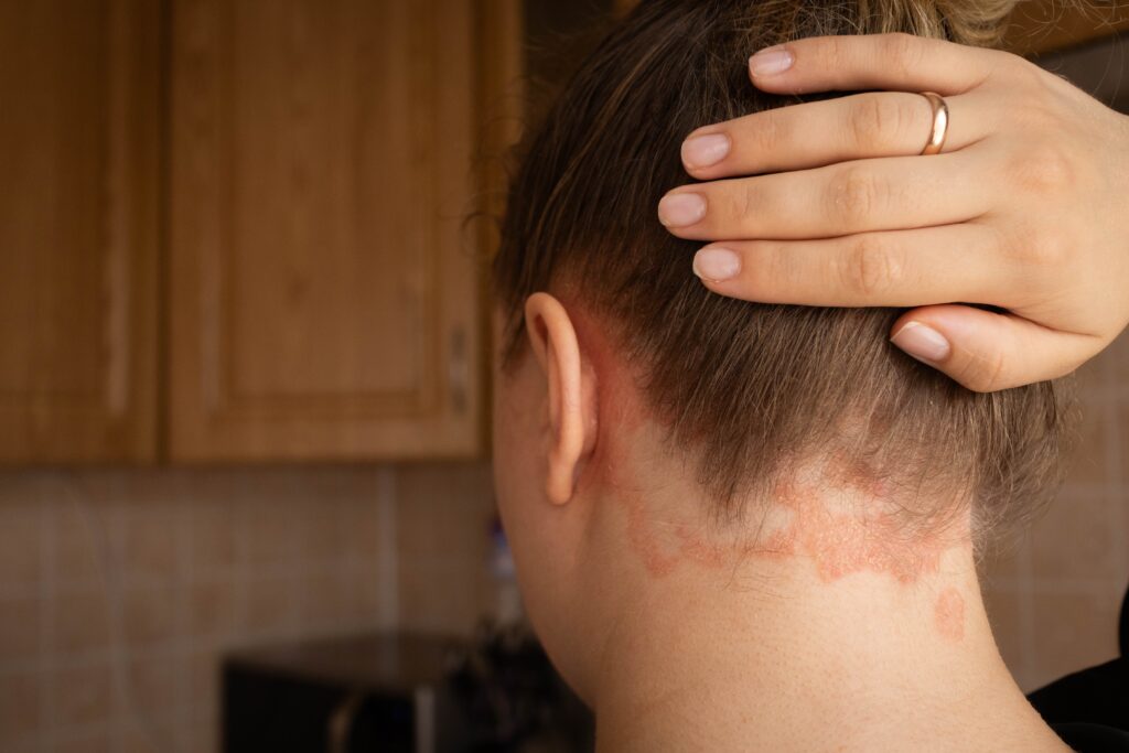 Woman shows psoriasis on the back of her scalp.