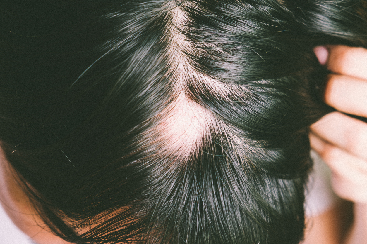 Alopecia What Is It & Can It Be Treated? Medical & Cosmetic