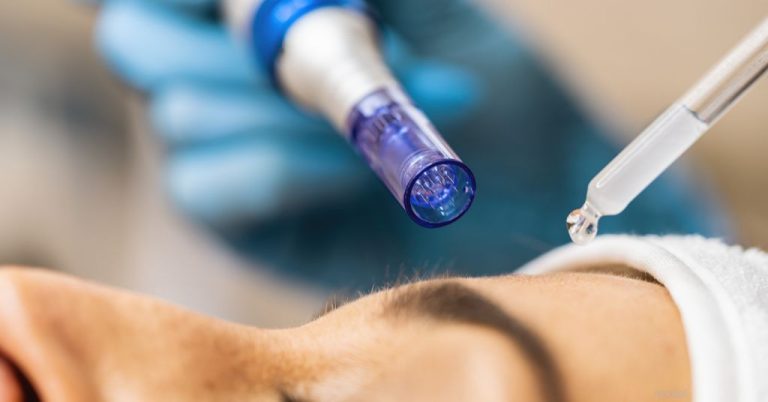 FAQ: Microneedling For Acne Scars | DermSurgery Associates