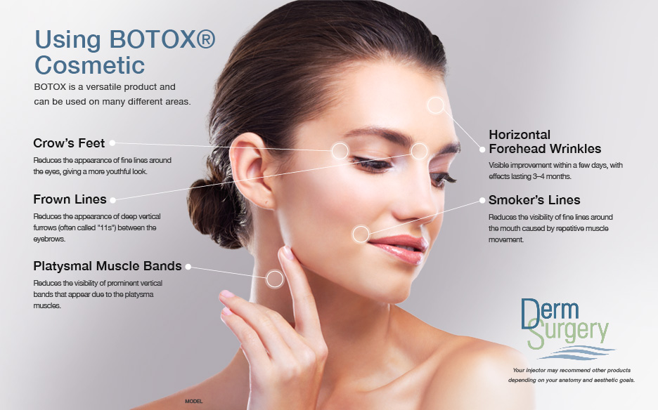 Diagram of Beneftis of Botox Cosmetics and how it can be used