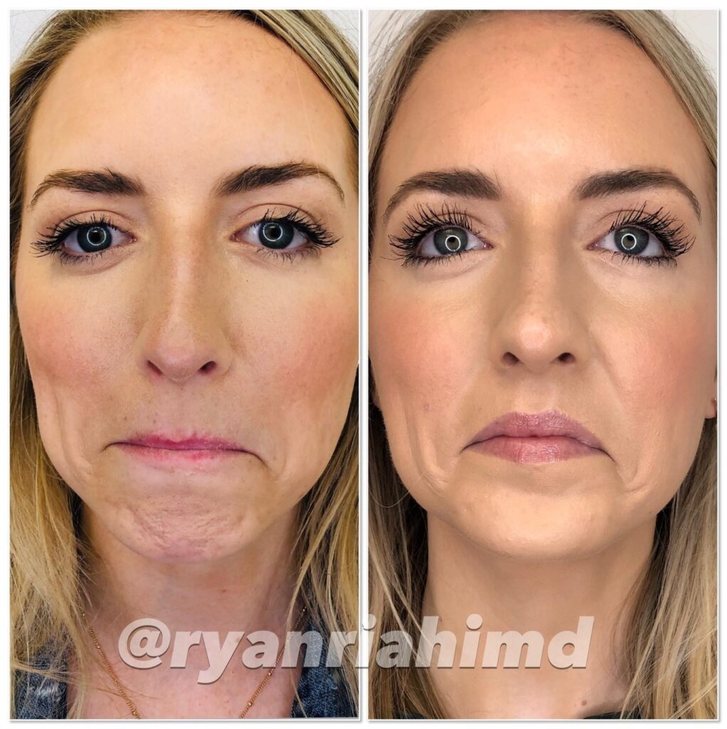 BOTOX Cosmetic in Houston and Greater Houston TX