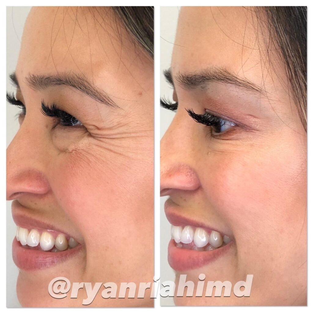 BOTOX® Cosmetic Case 47 Before & After Right Side | Houston, TX | DermSurgery Associates